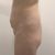 Mini abdominoplastía y mini lipo