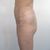 Mini abdominoplastía y mini lipo