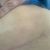 Pexia con implantes y mini lipectomia. 
