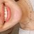 Blanqueamiento dental