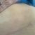 Pexia con implantes y mini lipectomia. 