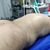 Lipoabdominoplastia con transferencia de lipoinjerto