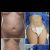 Lipo JPlasma + mastopexia con implantes