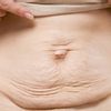 Abdominoplastia y Fonasa