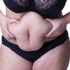 Abdominoplastia y Fonasa