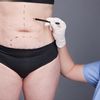 【El AbdominoTEST】¿Qué tanto sabes de la abdominoplastia?