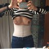ABDOMINOPLASTIA POSTOPERATORIO