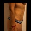 Tengo hecha una miniabdominoplastia en el 2018 con Dr.Rondano. ¿Bote mi dinero?