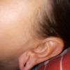 Operacion de una oreja por una extencion