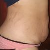Me opero el 28 de Junio!! Ayudenme