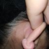 Extracción o tratamiento de queloide en oreja
