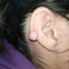 Extracción o tratamiento de queloide en oreja
