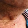 Lunar de carne? verruga? calcificación? melanoma? Benigno? hombre de 64 años. Zona cuello