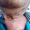 Lunar de carne? verruga? calcificación? melanoma? Benigno? hombre de 64 años. Zona cuello