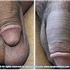 Fotos de resultados de implante para pene.
