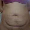 Abdominoplastia con el dr. Ruiz 