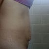 Abdominoplastia con el dr. Ruiz 