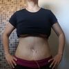 Abdominoplastia con el dr. Ruiz 
