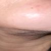 Lipopapada por canula