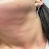Lipopapada por canula