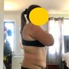 Me haré la abdominoplastía, pero dónde? Me ayudan??