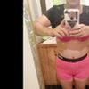 Vientre abultado después de la lipoabdominoplastia
