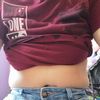 Vientre abultado después de la lipoabdominoplastia