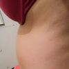 Vientre abultado después de la lipoabdominoplastia