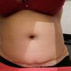 Vientre abultado después de la lipoabdominoplastia
