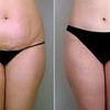¿Que doctor recomendarías para una abdominoplastia?