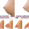 Doctor que opere mamas tuberosas?