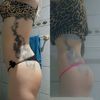 Me opere de gluteoplastia hace 3 dias
