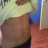 Lipo Vaser Dr. Ramírez 