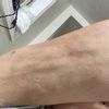 Fibrosis en los brazos con cinco semanas post operatorio
