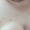 tengo hirsutismo, el laser no me sirvio, nada me hace efecto.