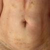 Fibrosis post liposuccion 