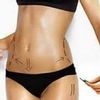 Necesito estar en un peso ideal para hacer una liposucción?