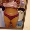 Ombligo y puntos infectados luego de una abdominoplastia