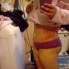 Ombligo y puntos infectados luego de una abdominoplastia
