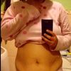 Ombligo y puntos infectados luego de una abdominoplastia