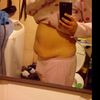 Ombligo y puntos infectados luego de una abdominoplastia