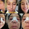 Desconforme con mi rinoplastia