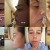 Desconforme con mi rinoplastia