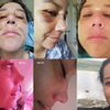 Desconforme con mi rinoplastia