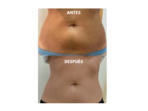 Plan reductivo abdomen $199.000 (HIFU + Emslim + Viora)