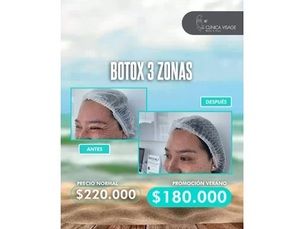 Botox 3 zonas con precio especial
