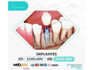 Promoción Implantes Dentales 🦷🦷 ahora por $450.000