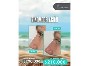 Promoción exclusiva Verano 🏖️- Rinomodelación por $210.000