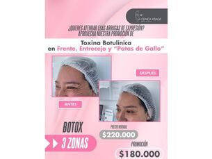 ✨ ¡Luce radiante y rejuvenecida con nuestra promoción de Botox! ✨