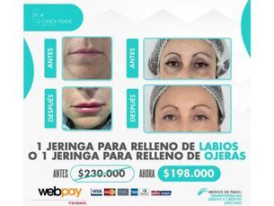 ✨¡Realza tu belleza! Rellenos de labios o Rellenos de ojeras por $198.000